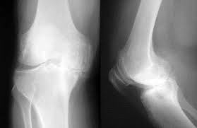 knee arthritis, knee DJD , osteoarthritis, arthritis, knee xray DJD